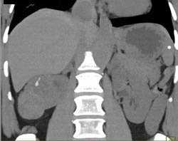 Renal Cell Carcinoma With Av Fistulae - CTisus CT Scan