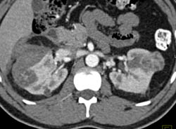 Multifocal Renal Cell Carcinoma With Bleed on Right - CTisus CT Scan