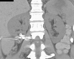 Embolization of Right Kidney Arteriovenous Malformation (AVM) - CTisus CT Scan