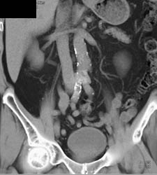 Transitional Cell Cancer (TCC) in Right Ureter- at S-i Level - CTisus CT Scan