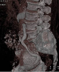 Obstructed Left Kidney and Ureter - CTisus CT Scan