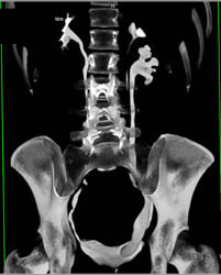 Duplicated Left Collecting System and Ectopic Uterocele - CTisus CT Scan