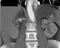 Renal Artery Aneurysm - CTisus CT Scan