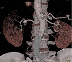 Renal Artery Aneurysm - CTisus CT Scan