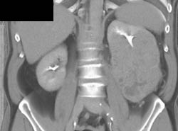 Renal Cell Carcinoma - CTisus CT Scan