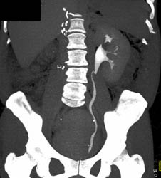 Normal CT Urogram S/P Right Nephrectomy - CTisus CT Scan