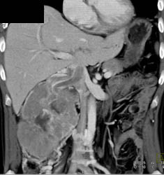 Renal Cell Carcinoma Invades the Renal Vein and Extends Into the IVC - CTisus CT Scan