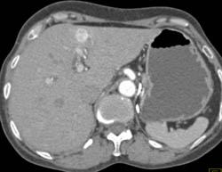 Renal Cell Carcinoma Metastatic to Liver and Pancreas - CTisus CT Scan