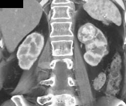 Vascular Renal Cell Carcinoma - CTisus CT Scan