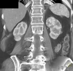 Vascular Renal Cell Carcinoma - CTisus CT Scan