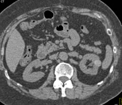 High Density Renal Cyst - CTisus CT Scan