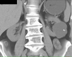 Renal Cyst - CTisus CT Scan