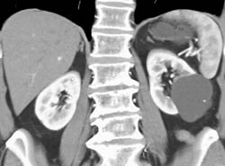 Renal Cyst - CTisus CT Scan