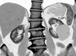 Renal Cyst - CTisus CT Scan