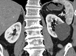 Renal Cyst - CTisus CT Scan