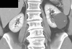 Renal Cyst - CTisus CT Scan