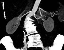 Renal Artery Stenosis on the Right - CTisus CT Scan