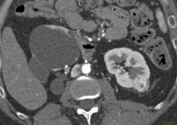 1 Cm Renal Cell Carcinoma - CTisus CT Scan