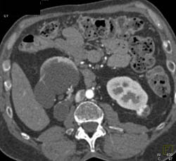 1 Cm Renal Cell Carcinoma - CTisus CT Scan