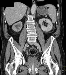 Renal Cyst - CTisus CT Scan