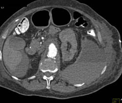 Renal Artery Aneurysm With Perirenal Bleed - CTisus CT Scan