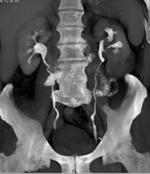 Transitional Cell Carcinoma - CTisus CT Scan