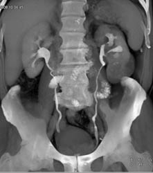 Transitional Cell Carcinoma - CTisus CT Scan