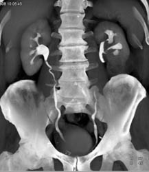 Transitional Cell Carcinoma - CTisus CT Scan