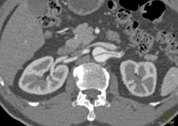 Aortic Dissection With Extension Into the Renal Artery - CTisus CT Scan