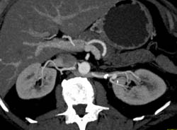 Left Renal Artery Aneurysm - CTisus CT Scan