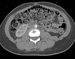 Acute Pyelonephritis - CTisus CT Scan