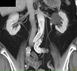 Obstructed Left Kidney Due to Stone in Left Ureteropelvic Junction (UPJ) - CTisus CT Scan