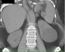 Renal Cyst - CTisus CT Scan