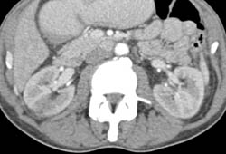 Acute Pyelonephritis - CTisus CT Scan