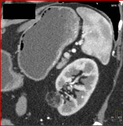 Angiomyelolipoma - CTisus CT Scan