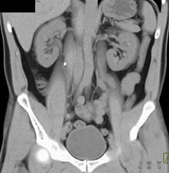 Stone in Proximal Right Ureter With Hydronephrosis - CTisus CT Scan