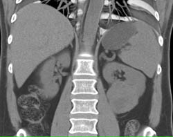 Renal Cell Carcinoma in Multiple Phases With Neovascularity - CTisus CT Scan