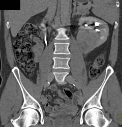 Renal Cell Carcinoma- Late Phase - CTisus CT Scan