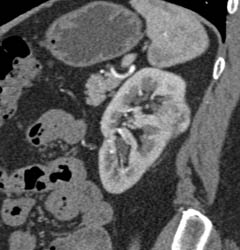 Renal Cell Carcinoma - CTisus CT Scan