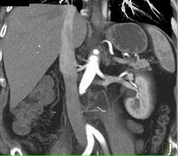 Renal Cell Carcinoma - CTisus CT Scan