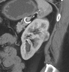 Renal Cell Carcinoma - CTisus CT Scan