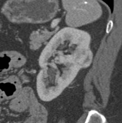 Renal Cell Carcinoma - CTisus CT Scan