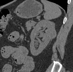 Renal Cell Carcinoma - CTisus CT Scan