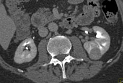 Renal Cell Carcinoma - CTisus CT Scan