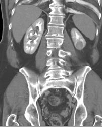 Renal Cell Carcinoma - CTisus CT Scan