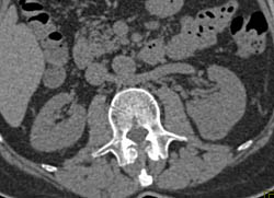 Renal Cell Carcinoma in Multiphase Acquisition - CTisus CT Scan