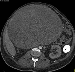 Large Renal Cell Carcinoma - CTisus CT Scan