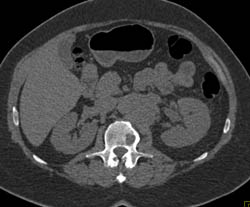 Renal Lymphoma - CTisus CT Scan