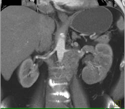 Renal Lymphoma - CTisus CT Scan