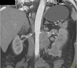 Renal Lymphoma - CTisus CT Scan